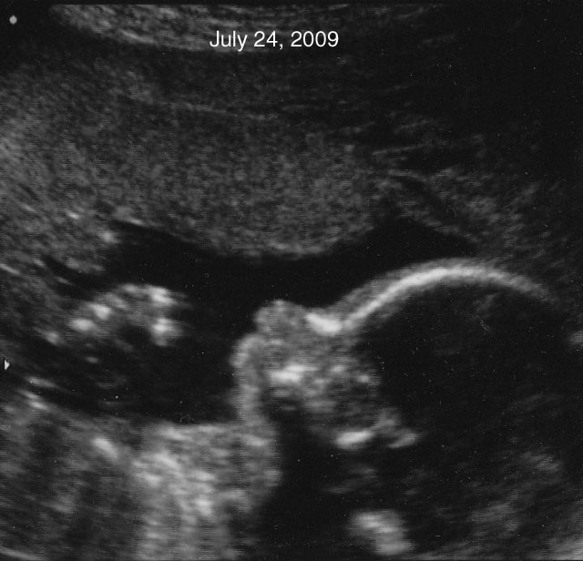 21.2a_090811.jpg - Second trimester sonogram, July, 2009