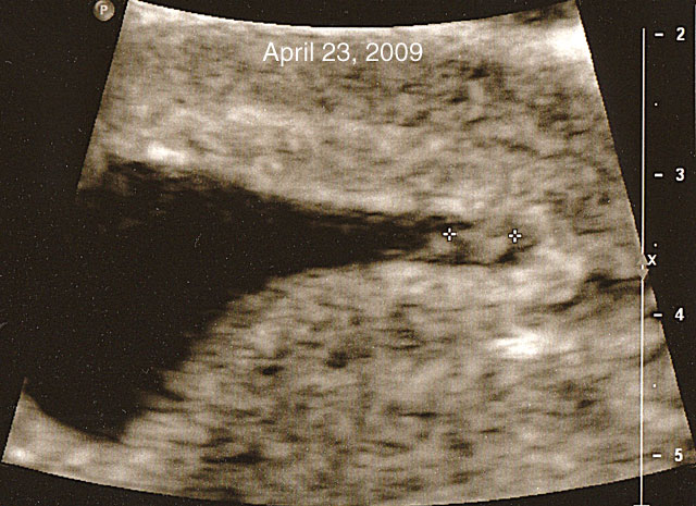 6.2b_090530.jpg - First trimester sonogram, April, 2009